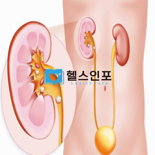 재발하는 내 몸안의 돌! 요로결석 예방수칙 TOP9과 최신 치료법으로 해결