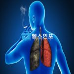 기흉 예방수칙 6가지와 최신 치료방법