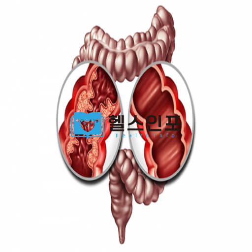 크론병 해결의 열쇠: 증상 분석, 원인 탐구, 예방과 치료의 비밀