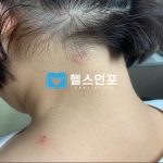 대상포진의 A to Z: 증상의 식별, 발병 원인, 집에서 시작하는 예방, 그리고 전문가의 치료법