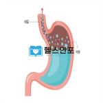 역류성 식도염 7가지 예방수칙과 효과적인 치료방법