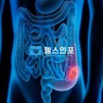 대장암과의 전쟁: 증상, 원인 및 최신 치료법 소개