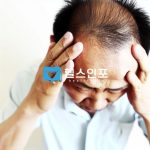 탈모 고민 해결법: 원인부터 증상, 예방, 치료까지 철저한 가이드