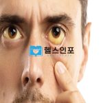 효과적인 황달 치료방법과 예방수칙 BEST 8