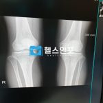 골다골증 예방수칙 TOP 10과 효과적인 치료