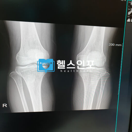 골다골증 예방수칙 TOP 10과 효과적인 치료