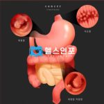 크론병 환자와 그 가족을 위한 필독! 치료와 관리의 실전 가이드