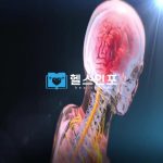 다발성 경화증