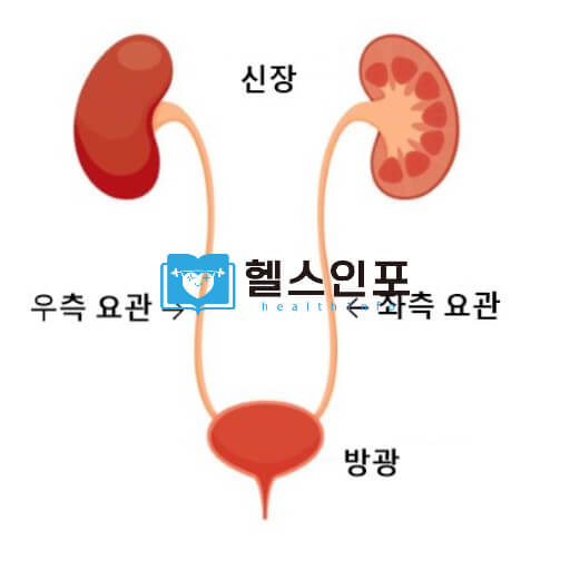 고통스러운 3대 통증! 요로결석 6가지 증상과 원인분석
