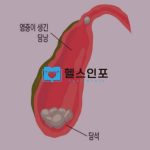 담석증 예방수칙 TOP7과 효과적인 최신 치료방법