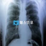 기흉의 주요 증상과 원인: 가슴 통증부터 심장 문제까지