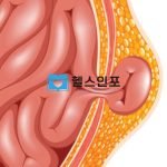 탈장 증상 탈장 원인
