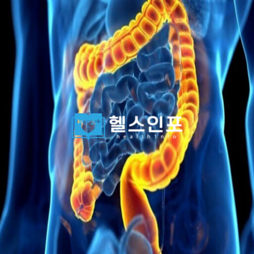 대장암 5가지 초기증상ㅣ대장암1~4기 생존율과 각 치료법