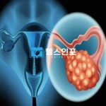 난소암 초기증상과 난소암1~4기 생존율과 수술