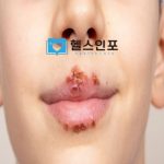 한포진 한 포진 한포진 주요증상과 예방
