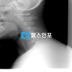 갑상선 목부음 증상