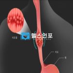 식도암 초기증상