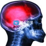 풍증상 - 뇌줄중 원인과 초기증상 및 예방법