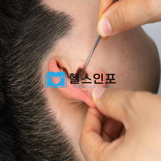 한쪽 귀 먹먹한증상 대처방법 - 귀청소