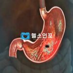 위말트 림프종