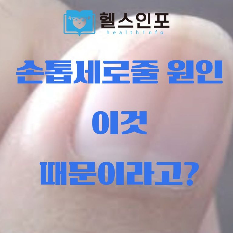 손톱 세로줄 원인
