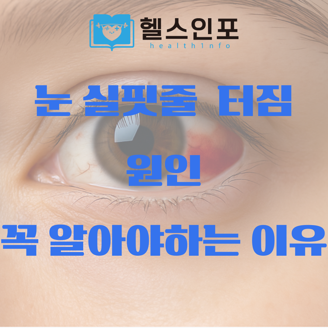 눈 실핏줄 터짐